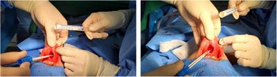 Prophylactic antibiotics may not be necessary for transoral endoscopic thyroidectomy